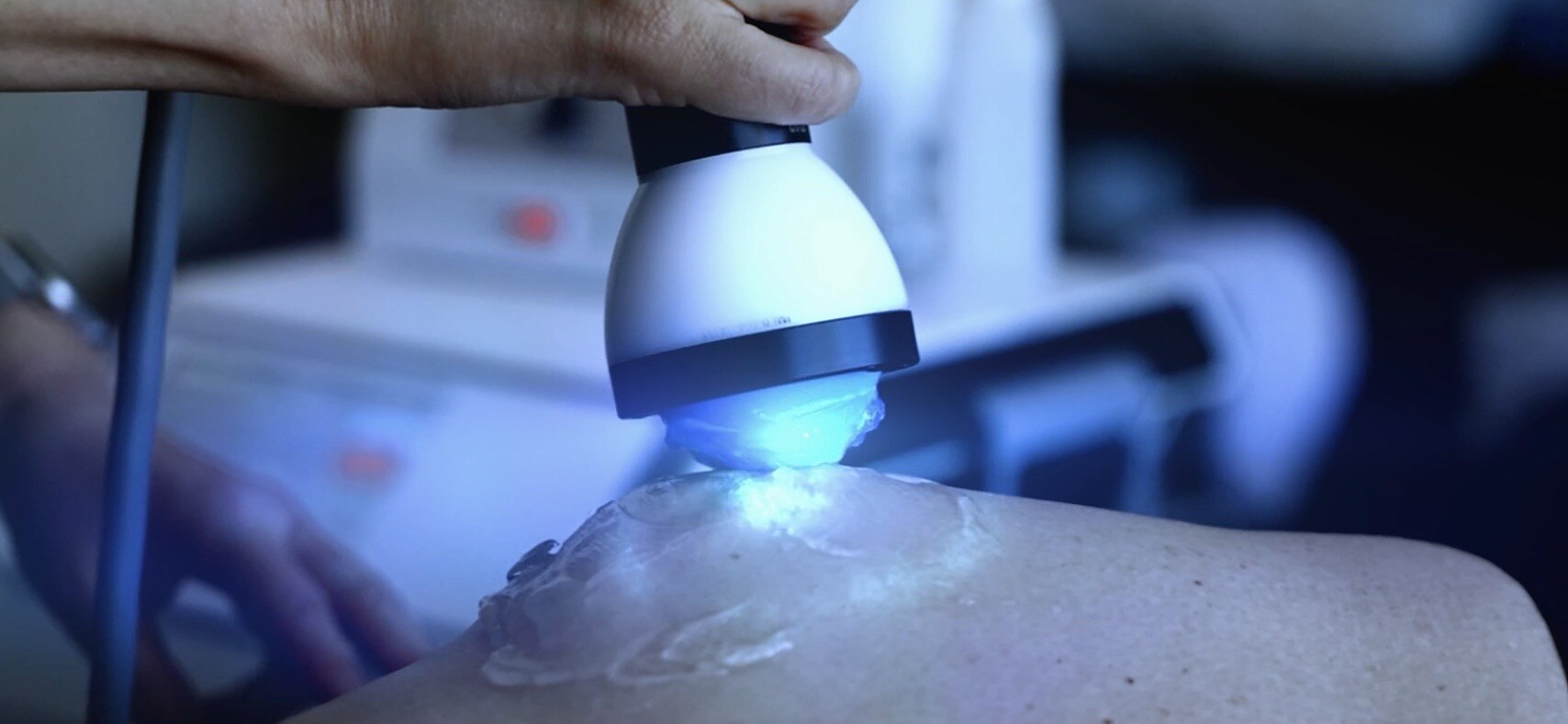 StemWave shockwave therapy device delivering treatment with its characteristic blue glow